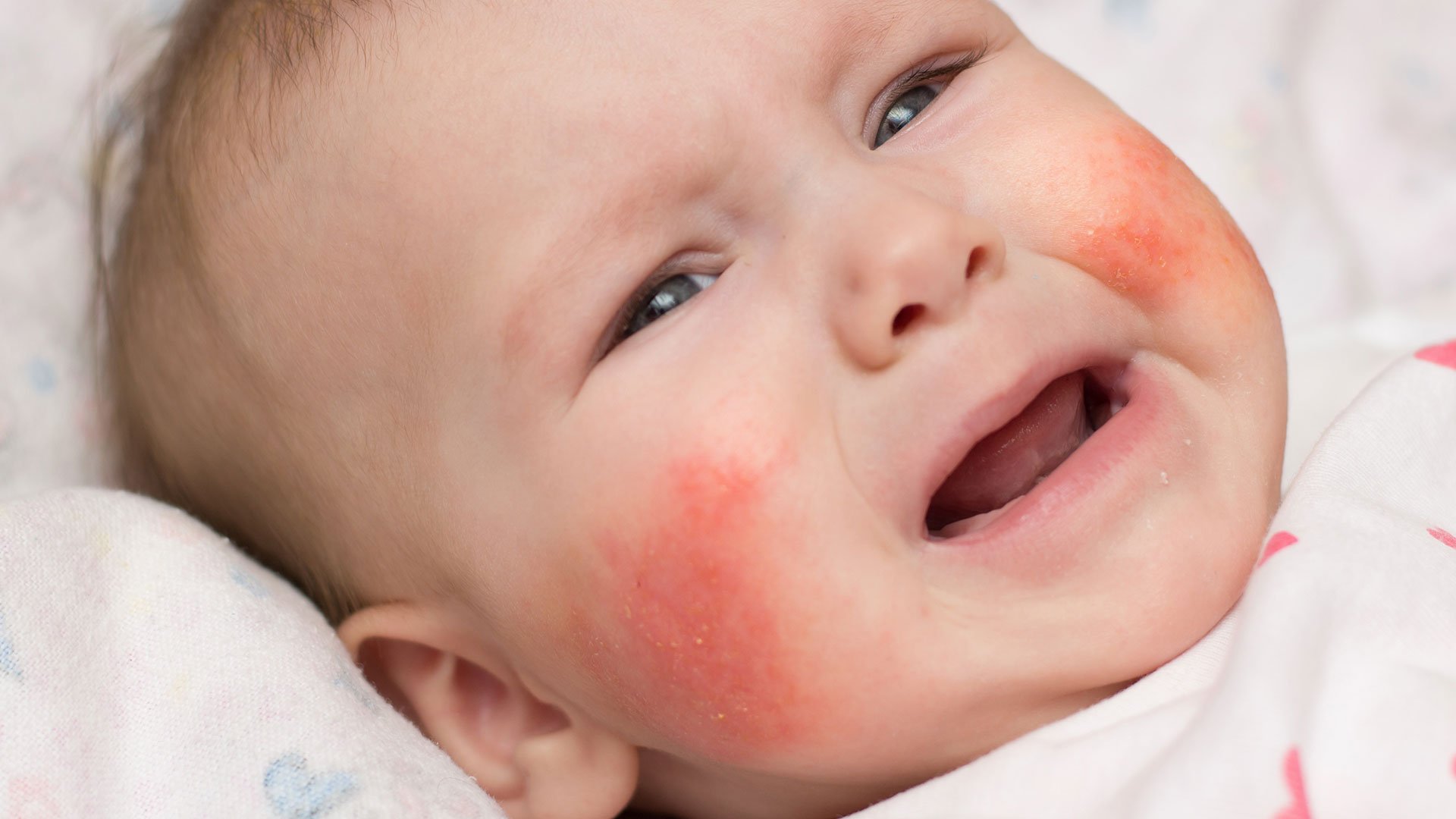 Atopic Eczema  Allergy and Asthma Centre