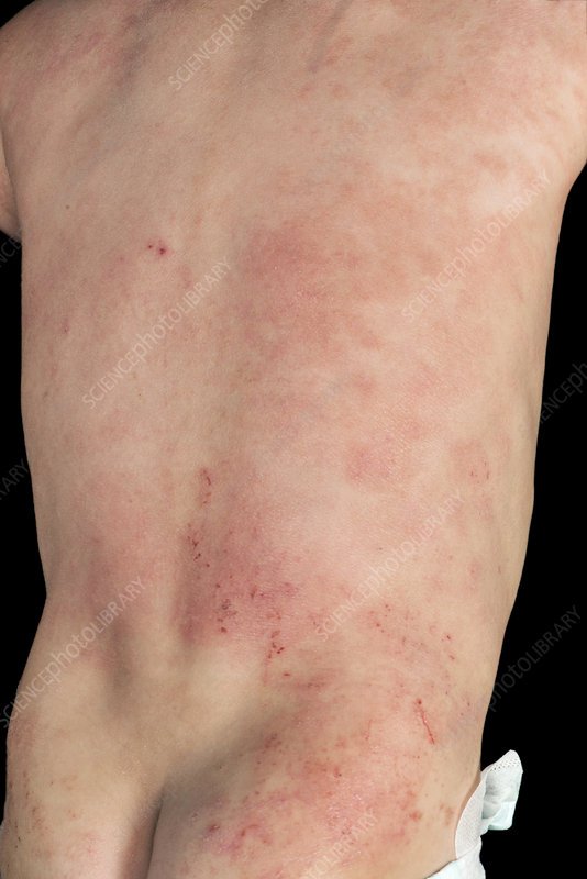 Atopic eczema on a baby