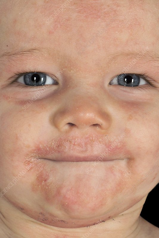 Atopic eczema on a baby