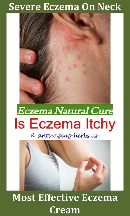 Aveeno Eczema Therapy Cream,is lubriderm good for eczema.What Causes ...