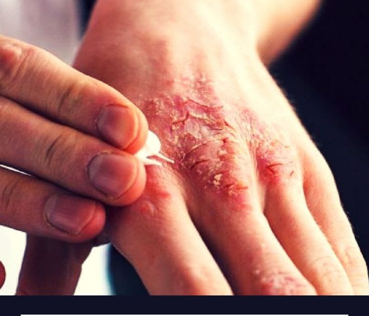 aweuxdesign: How To Get Rid Of Black Eczema Marks