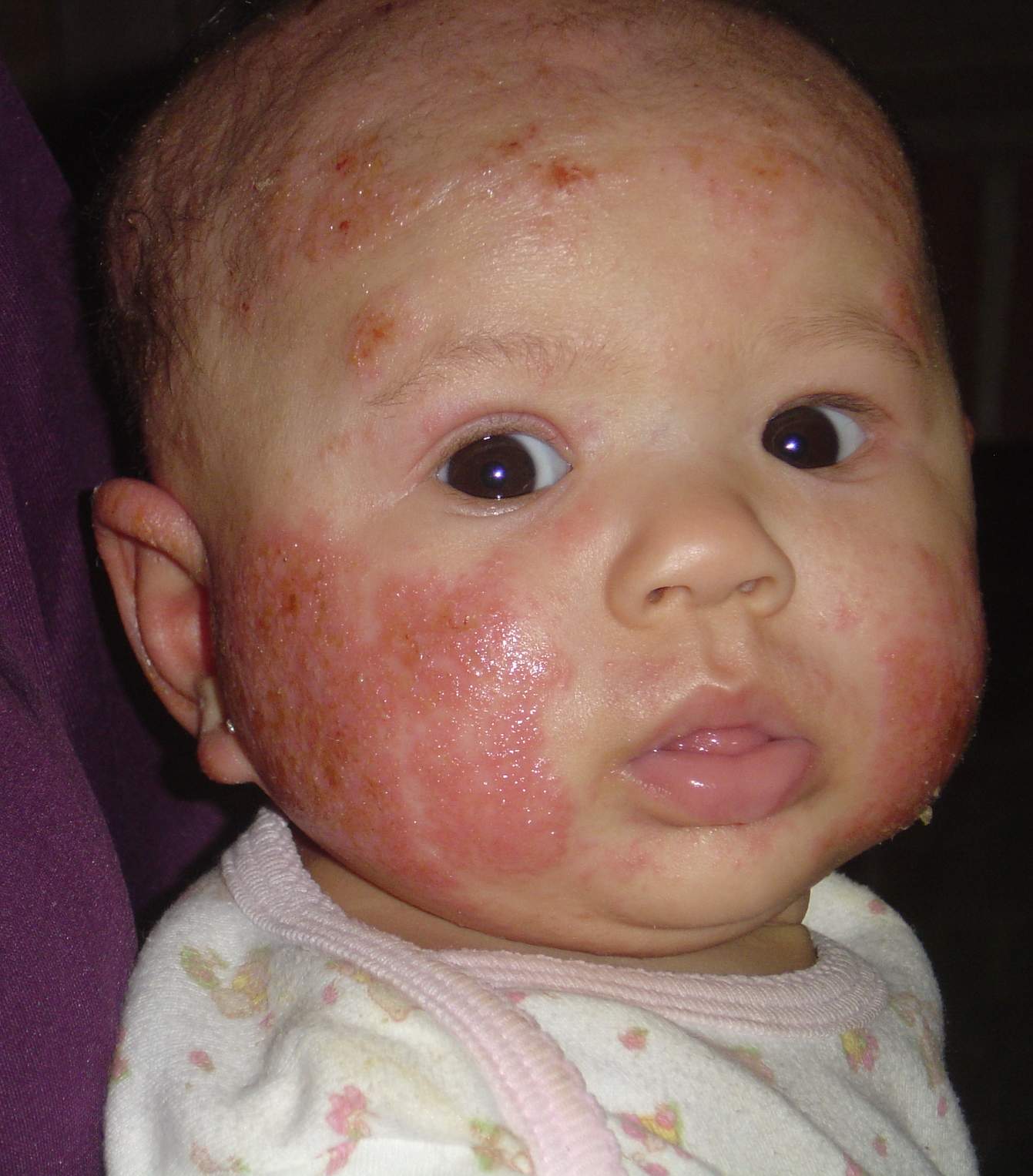Baby Acne Cure and Treatment: Baby Eczema Pictures : What Looks Like ...