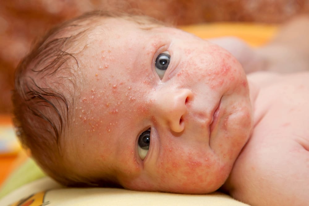Baby Acne Or Eczema Pictures