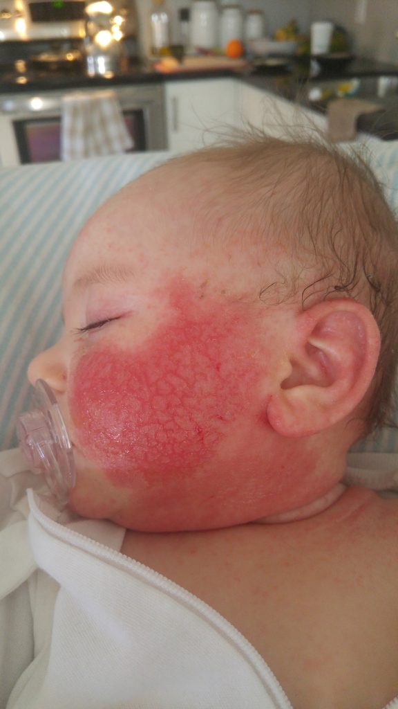 Baby battles living hell as her skin burns, peels off and scabs after ...