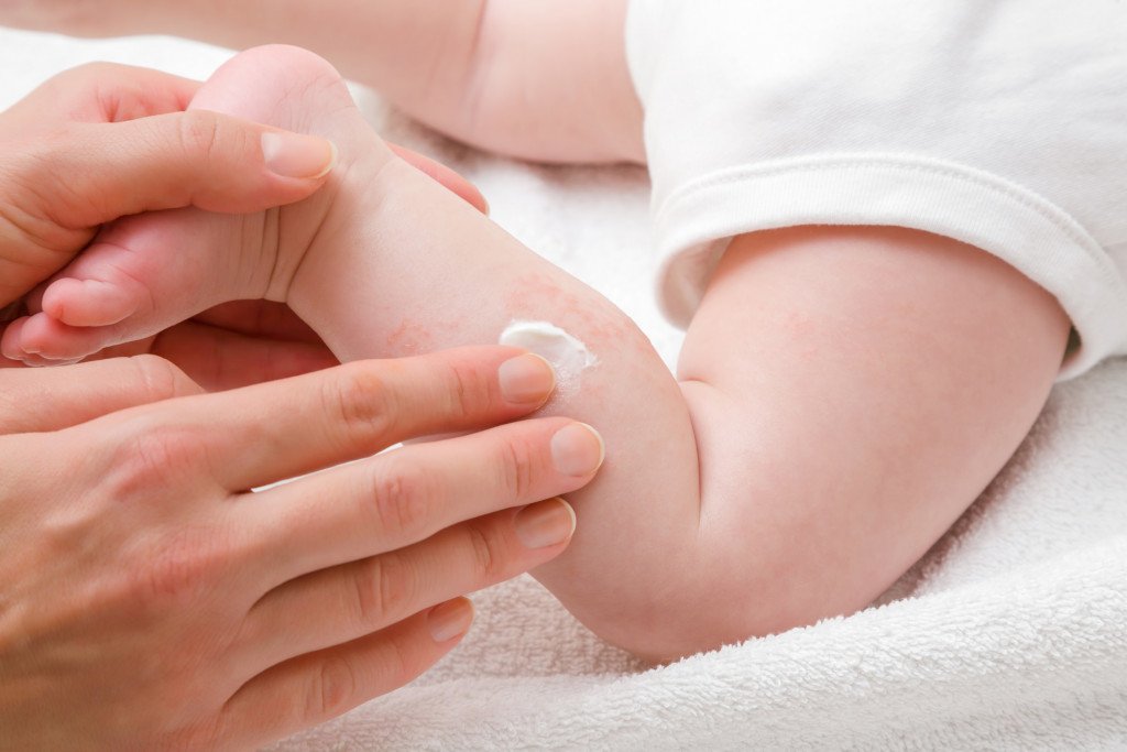Baby Eczema: Causes and Remedies