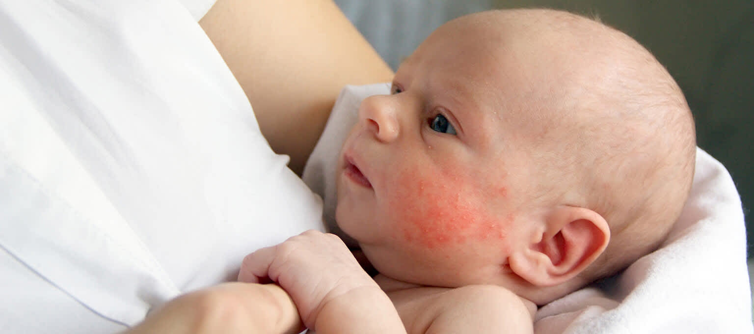 Baby Eczema: Causes and Treatment Options