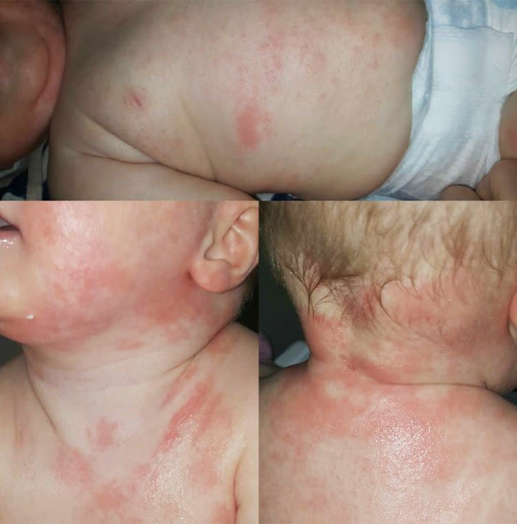 Baby Eczema: Causes and Treatments