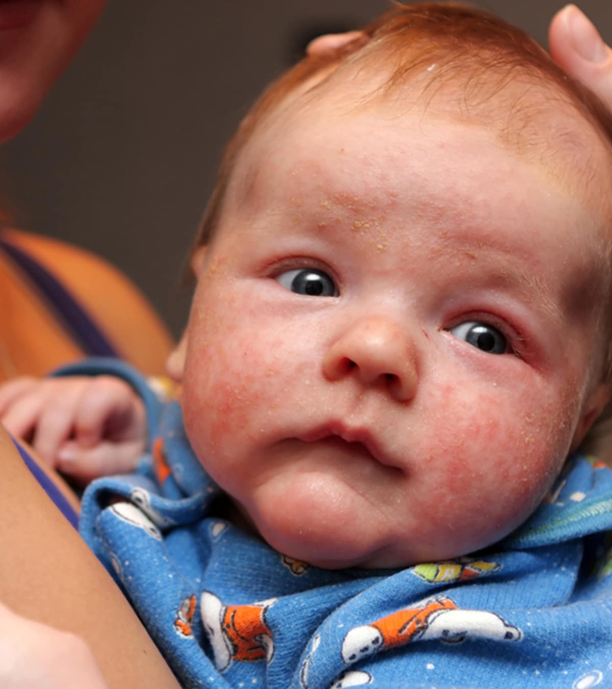Baby Eczema: Causes, Symptoms, Treatment &  Home Remedies