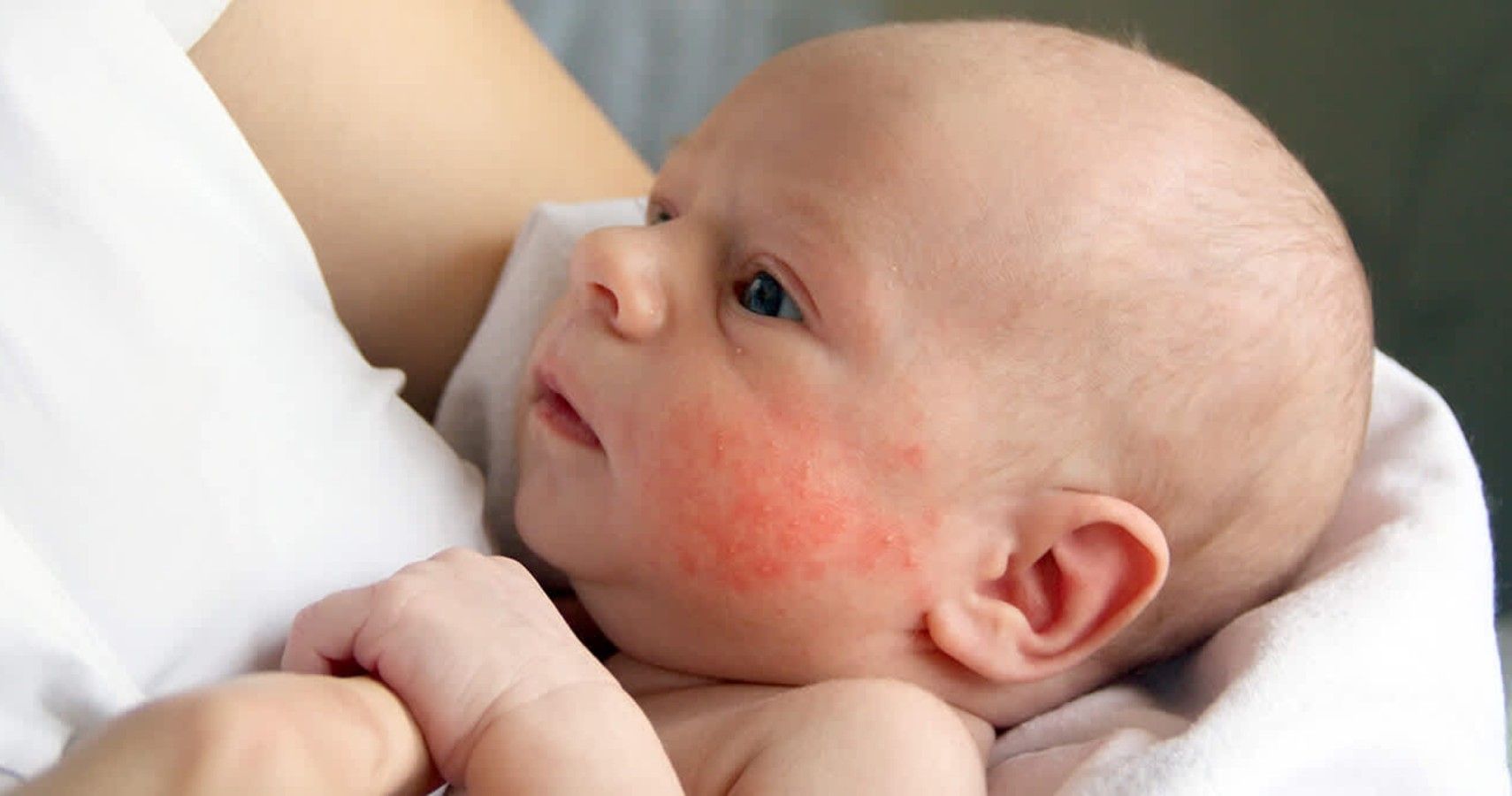 Baby Eczema: Causes, Symptoms, &  Treatments