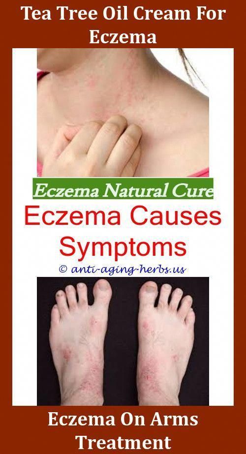 Baby Eczema Cream Best Cream For Nummular Eczema How To Care For Eczema ...