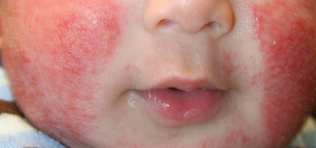 Baby Eczema Flare Up Causes