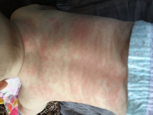 Baby eczema gets worst