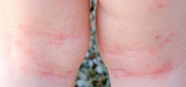 Baby Eczema On Legs Treatment