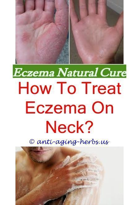baby eczema pictures causes of eczema on hands and feet