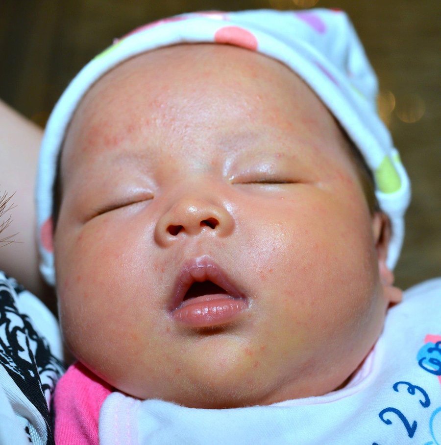 Baby Eczema Singapore
