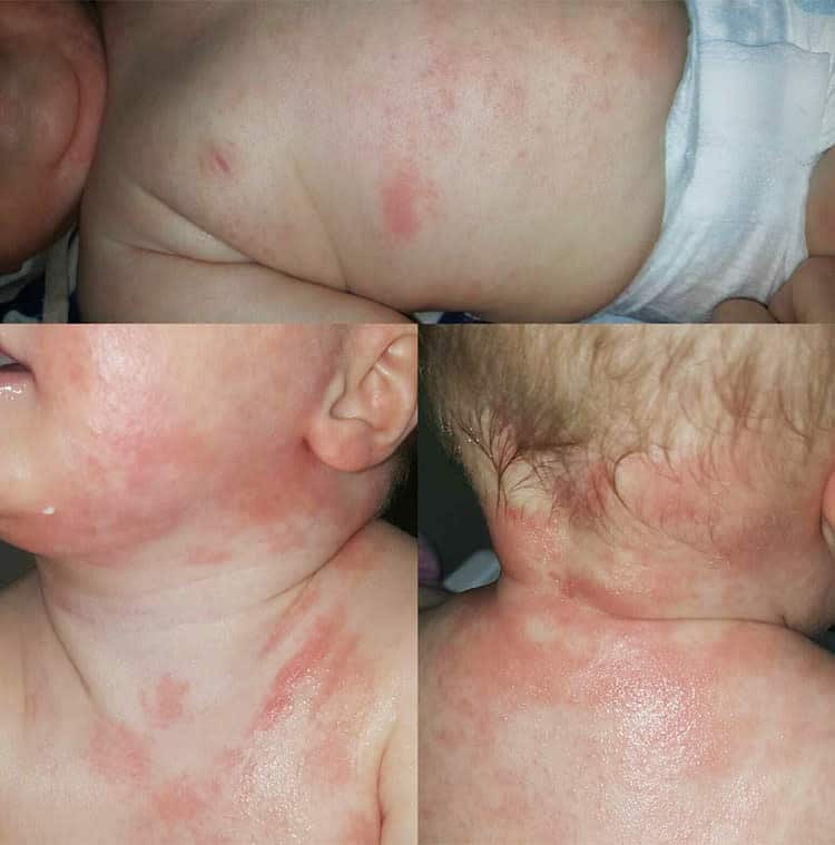 Baby Eczema: Symptoms, Causes and Treatments