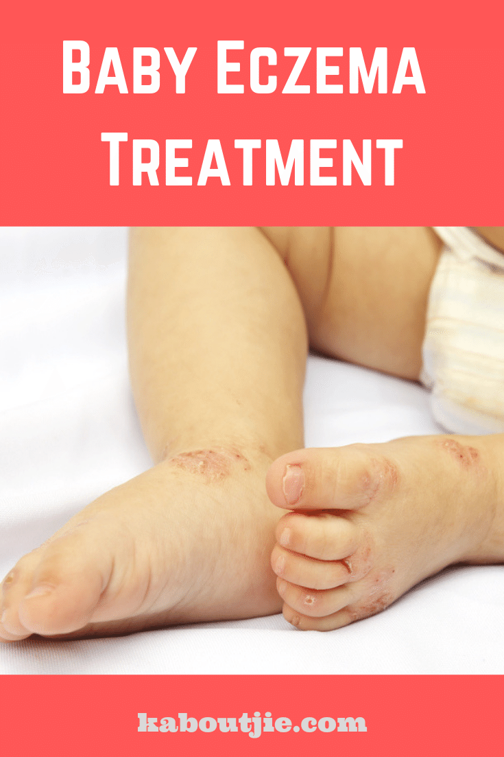 Baby Eczema Treatment Options You Need To Know