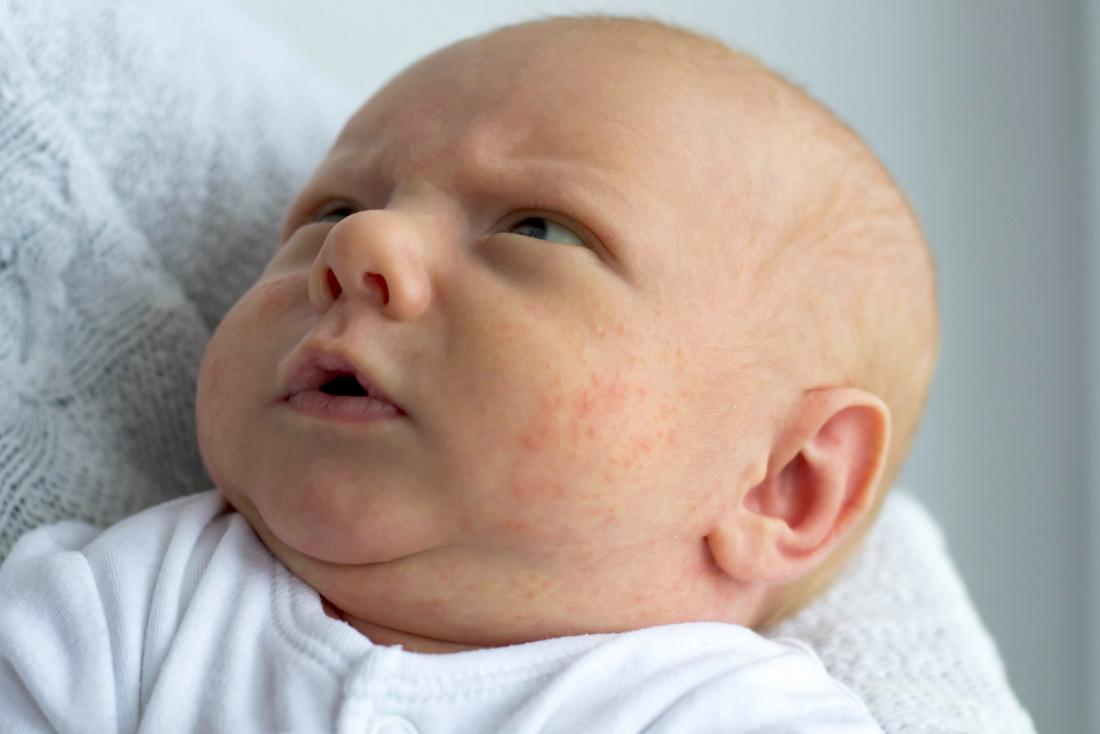 Baby eczema vs baby acne, THAIPOLICEPLUS.COM