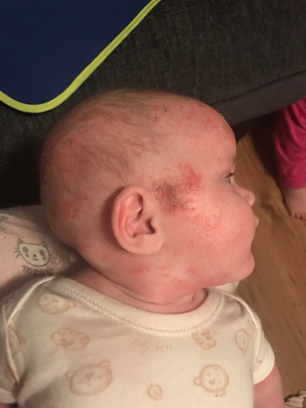 Baby girl with eczema so bad it