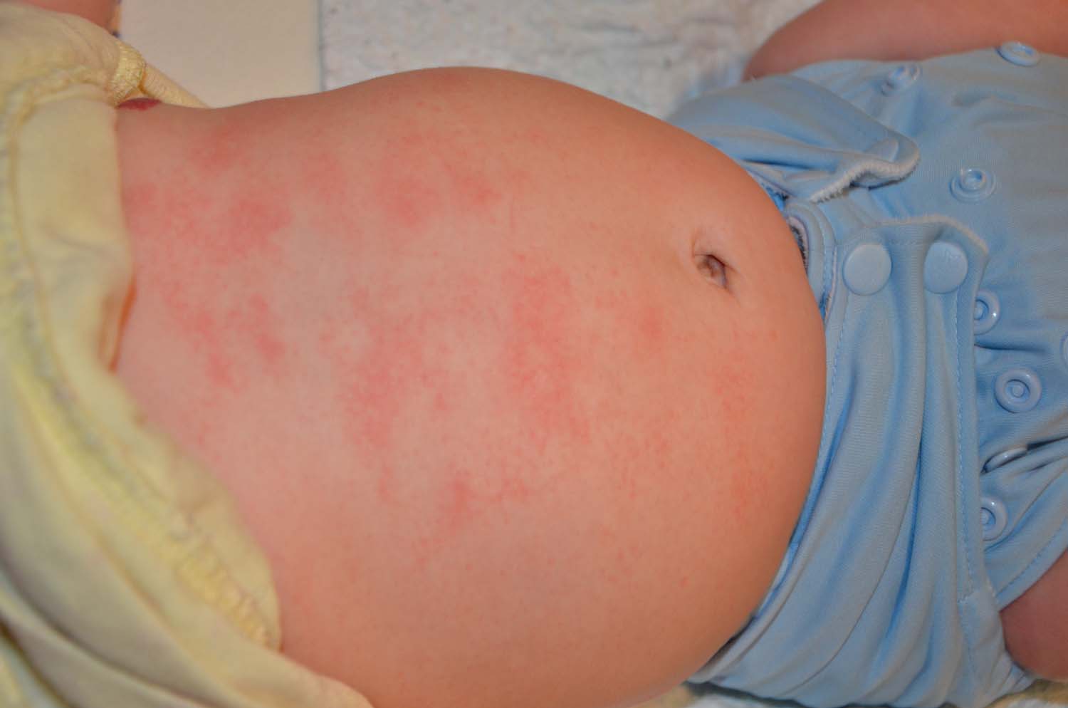 Baby has constant skin rash