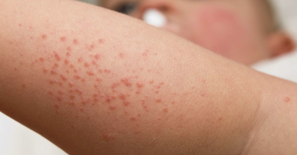 Baby heat rash: Types, diagnosis, and treatment