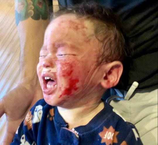 Baby left screaming in pain from steroid cream that left ...