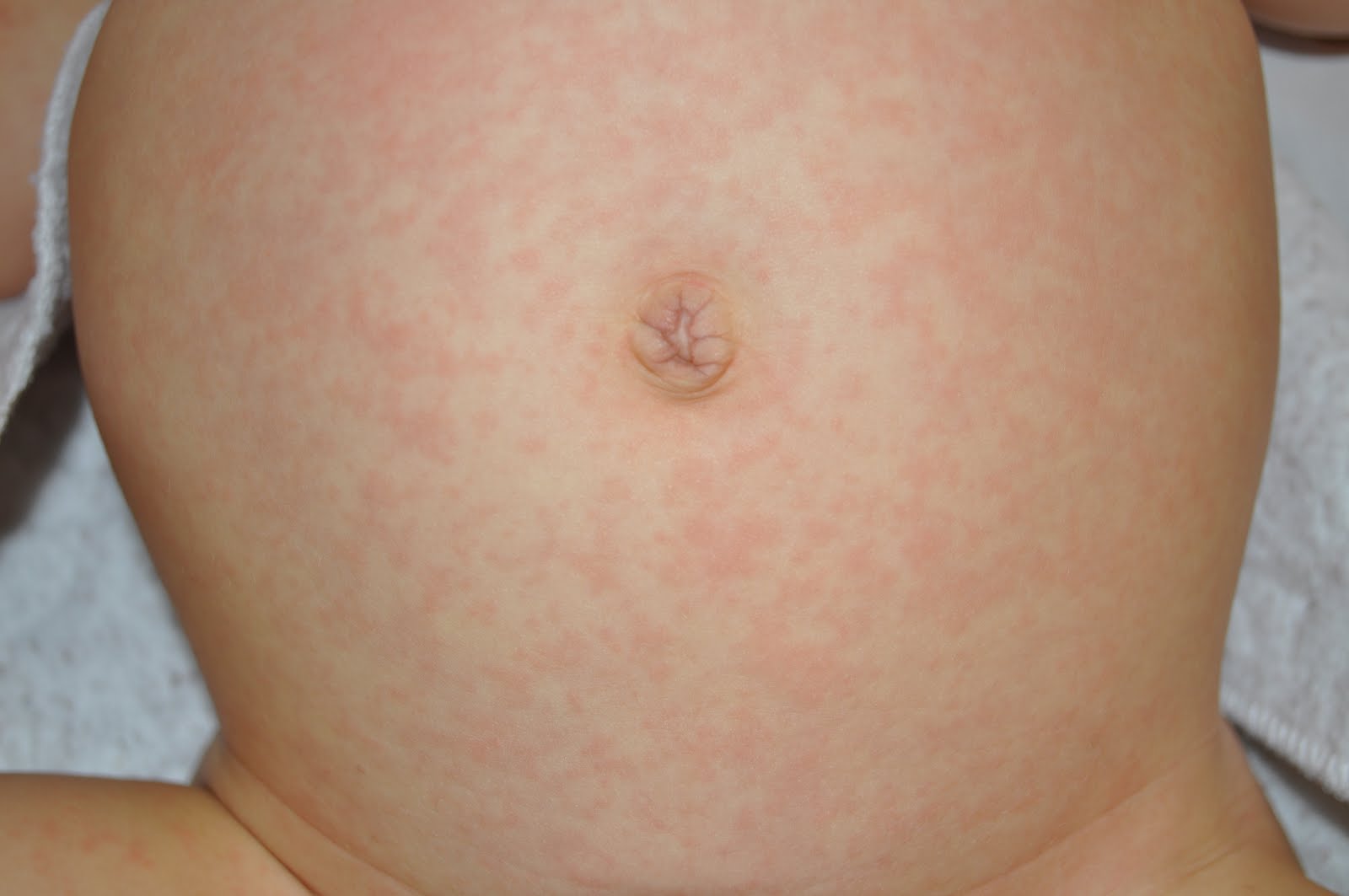 Baby Rash Pictures, Causes, Treatments