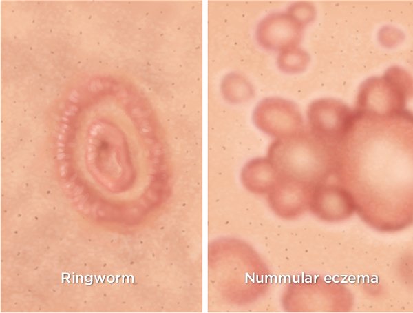 Baby Ringworm or Eczema? Know The Difference!