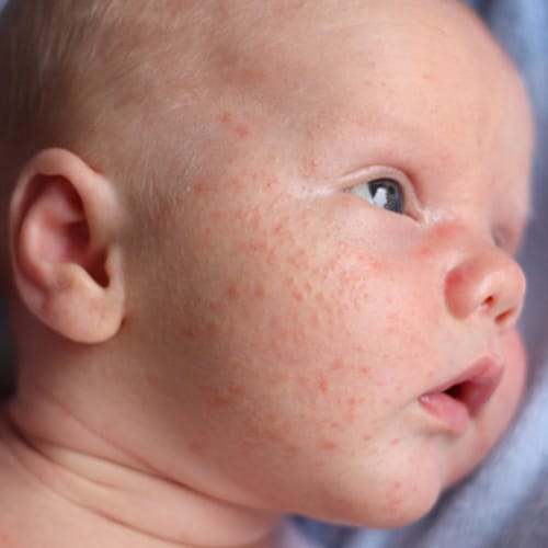Baby Skin Issues and Conditions