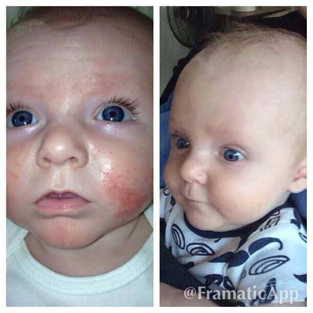 Baby suffer from eczema (left) after using Seacret mud soap and body ...