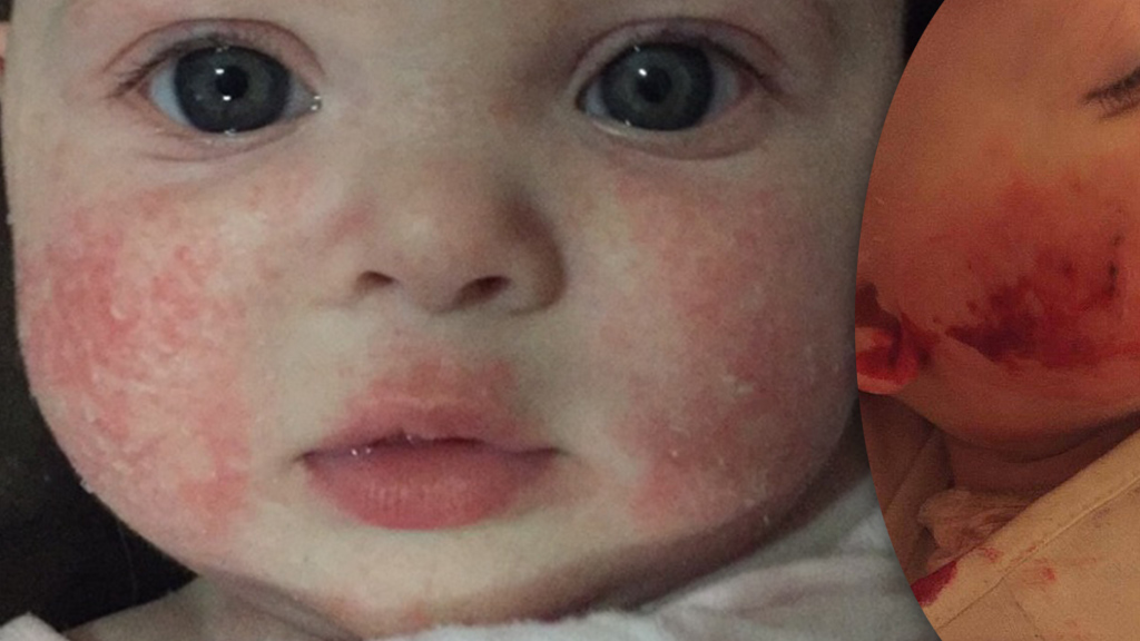 Baby With Severe Eczema Has To Wait A Year For Treatment