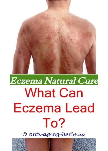 Bad eczema on hands.How to stop eczema from burning.Eczema ...