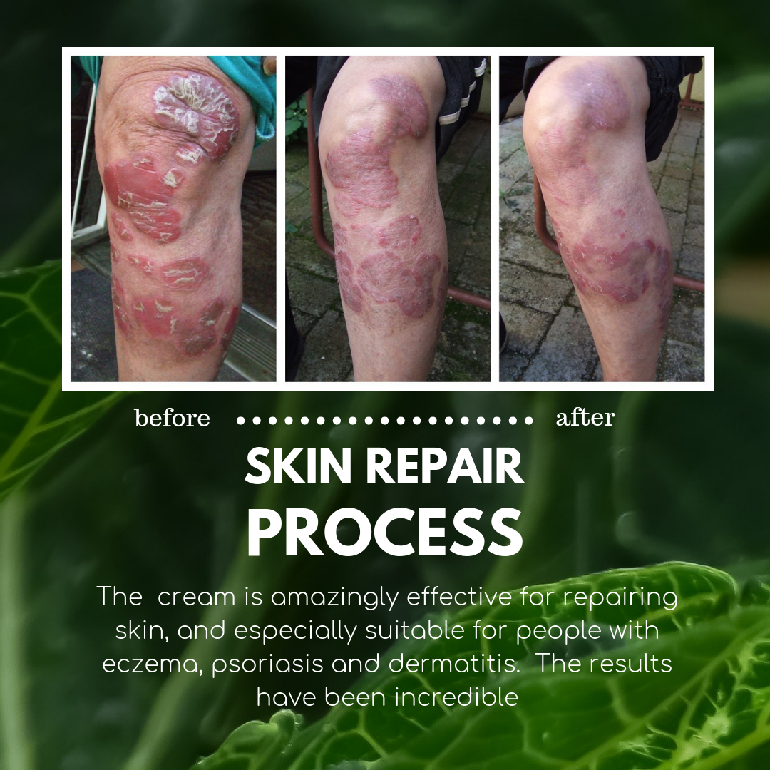 Basix Skin Defence Cream Natural Healing Eczema Psoriasis ...