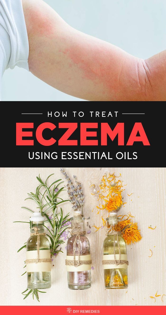 Best Cream For Itchy Eczema