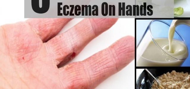 Best Cures For Eczema On Hands