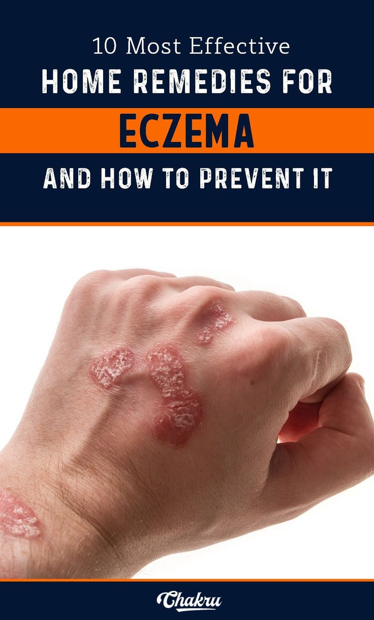 Best home remedies for Eczema and how to prevent it completely.