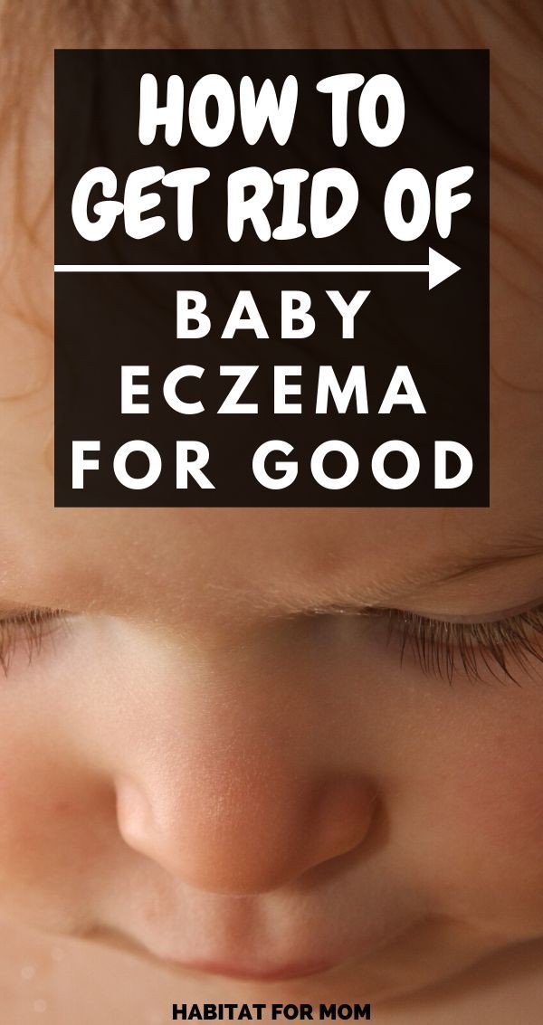 Best Remedies for Baby Eczema (ultimate list) in 2020