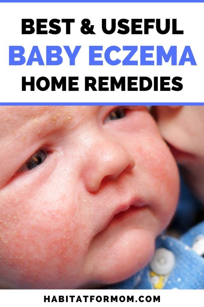 Best Remedies for Baby Eczema (ultimate list) in 2020 ...