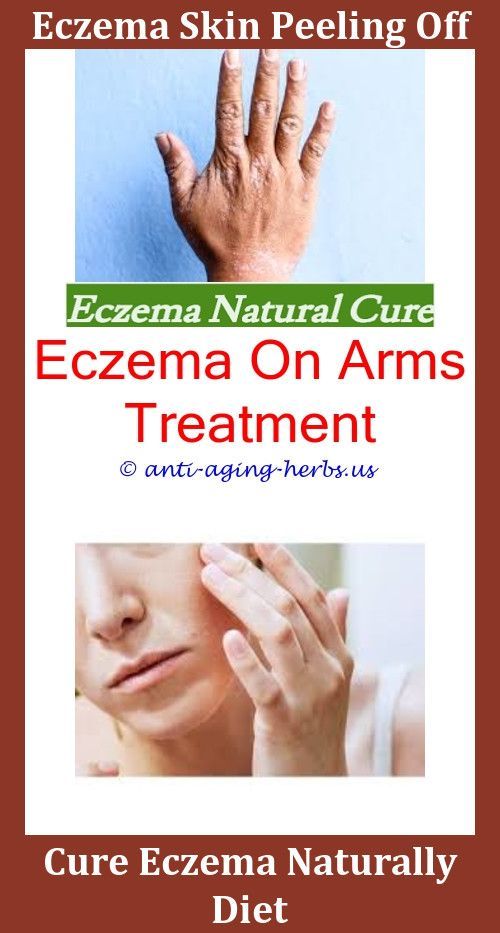 Best Soap And Lotion For Eczema,sulfur ointment for eczema.Weeping ...