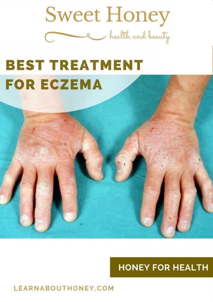 Best Treatment for Eczema _ Sweet Honey