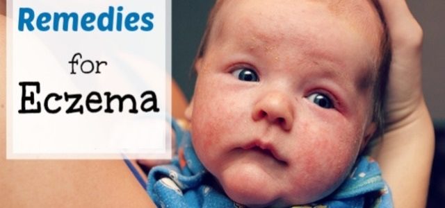 Best Way To Treat Eczema In Babies