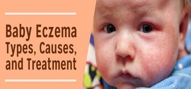 Best Way To Treat Eczema On Babies