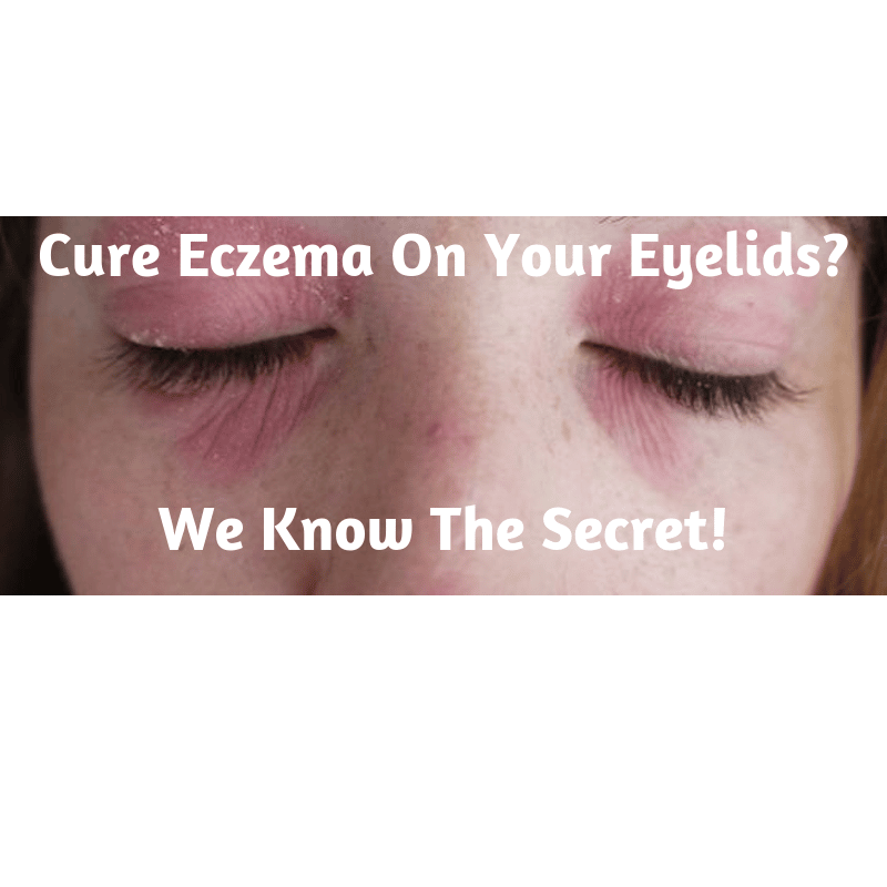 Best Way To Treat Eczema On Face