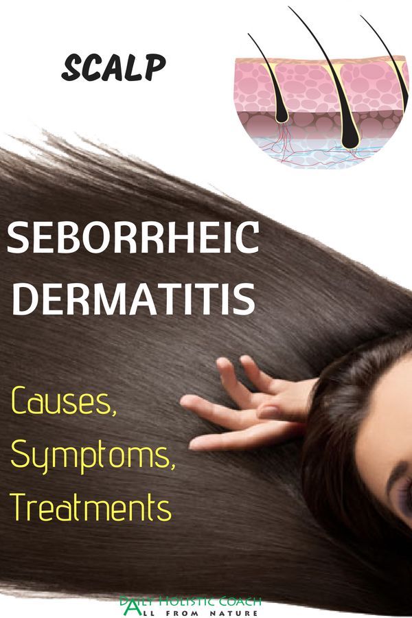 Best Way to Treat Seborrheic Dermatitis