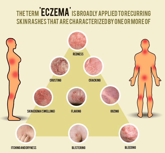 Brief Guidance on Different Types of Eczematous Dermatitis