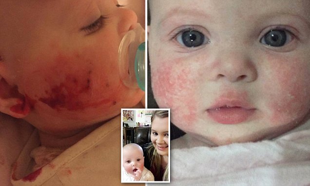 Brisbane baby with severe eczema on her face told she