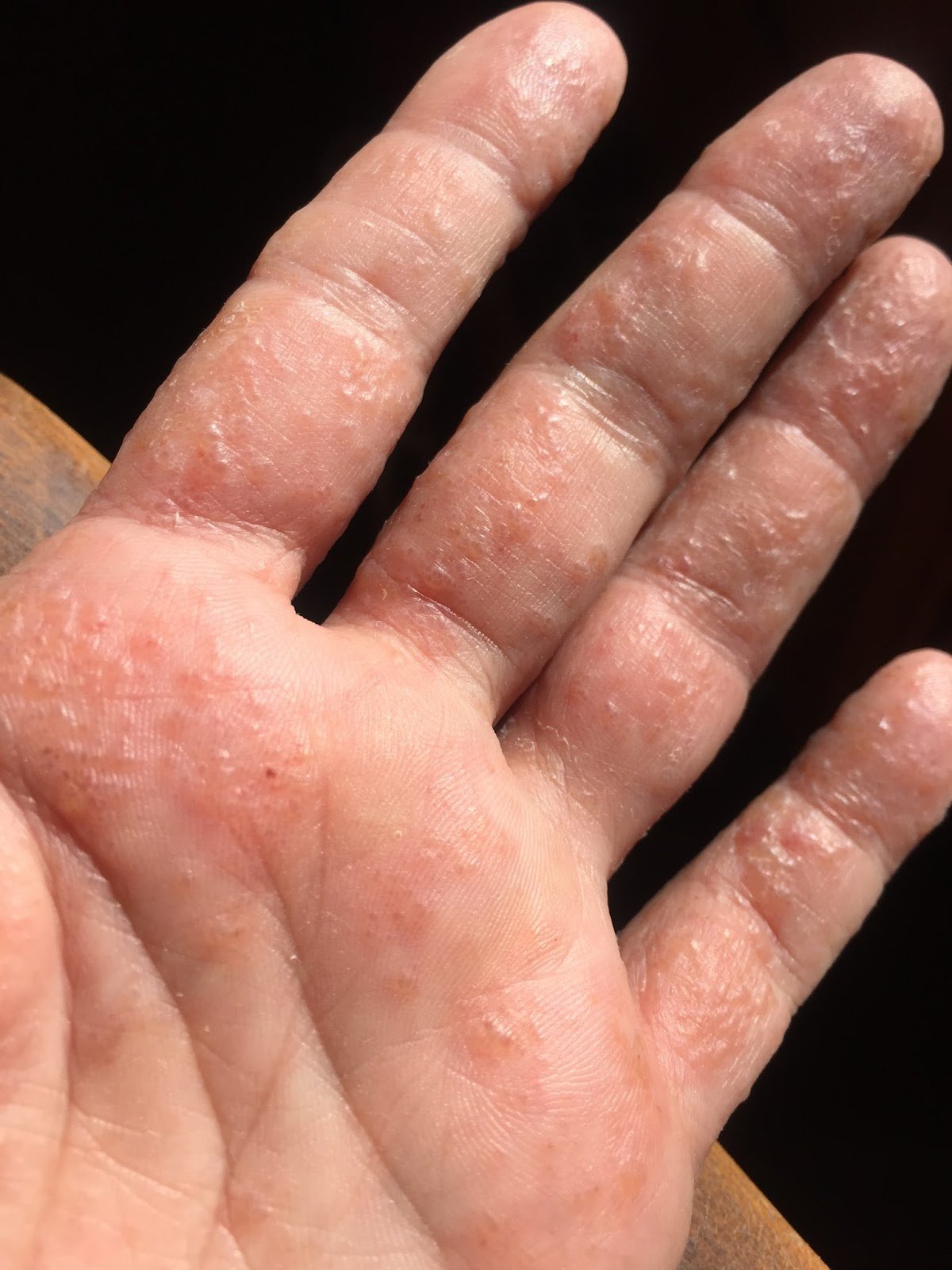 Bubbles and Blisters: What is it?!?