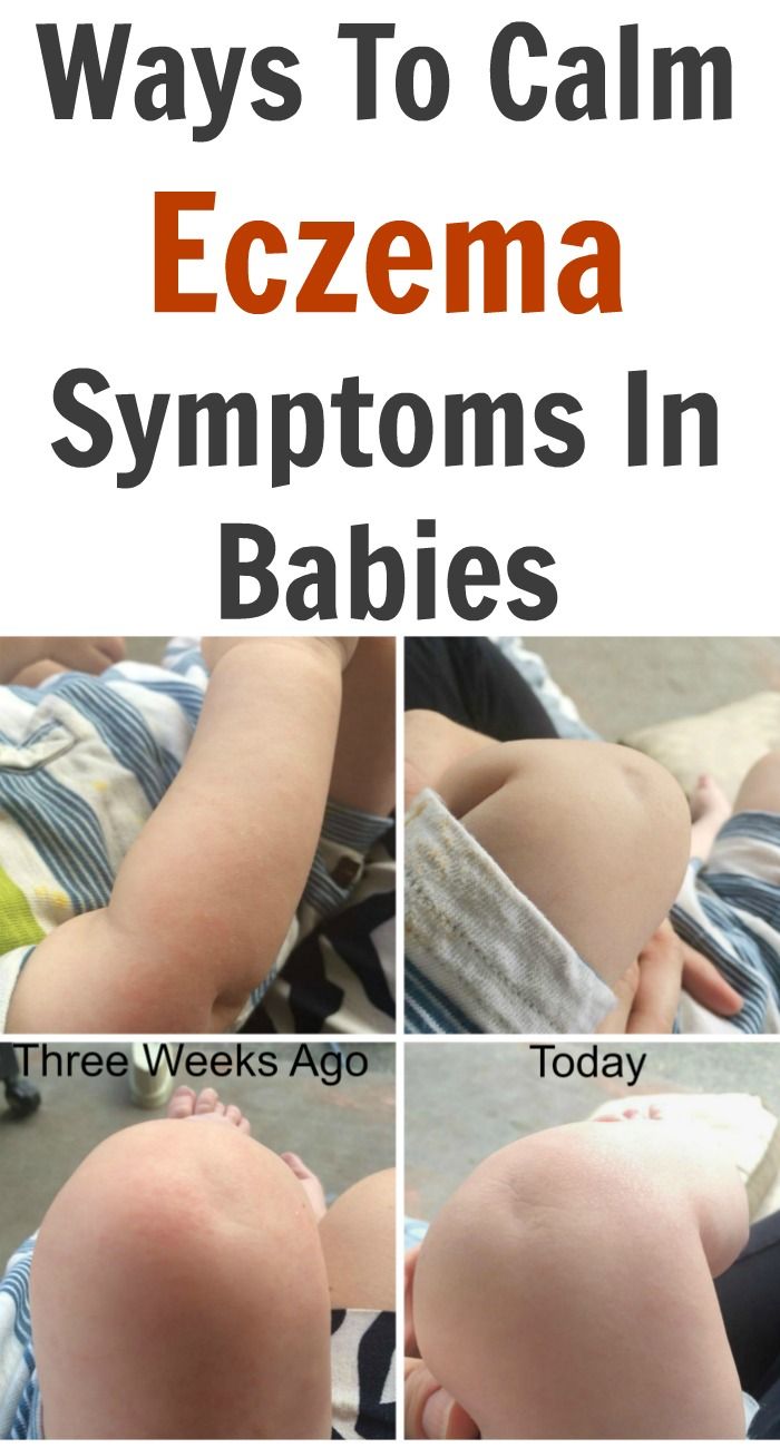 calm eczema symptoms in Babies