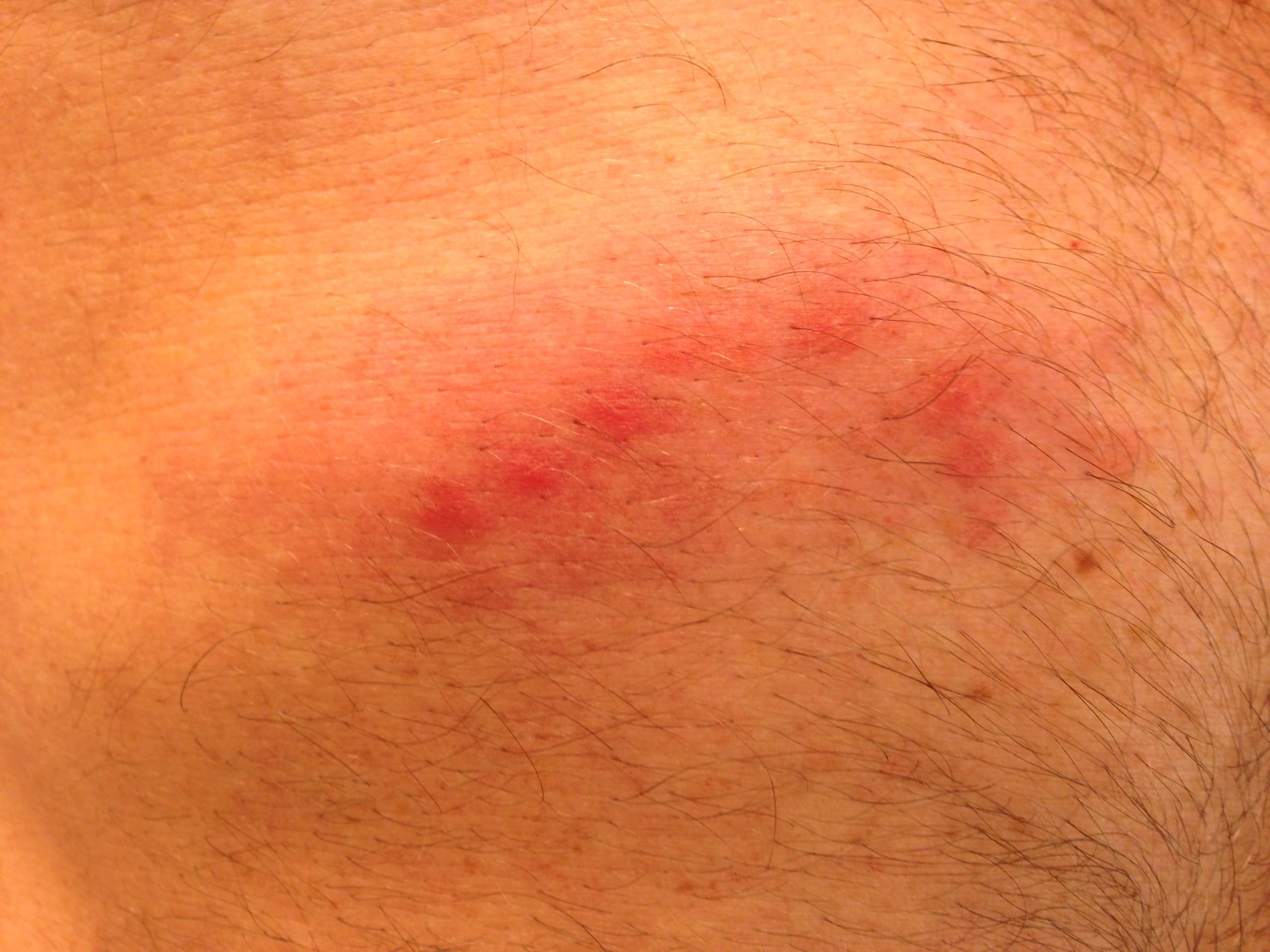 Can a summertime rash that looks like insect bites be something else ...
