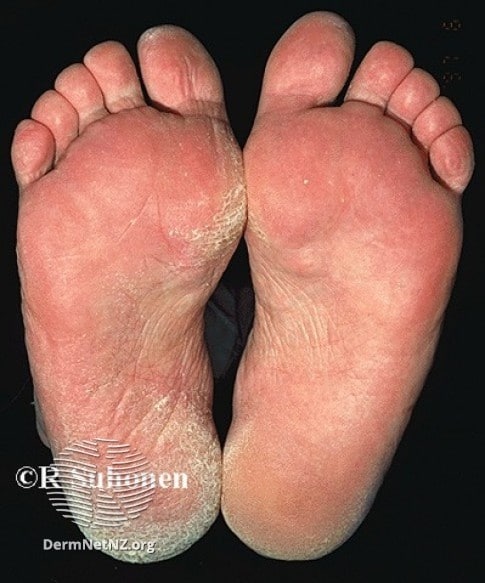 Can athletes foot trigger eczema?